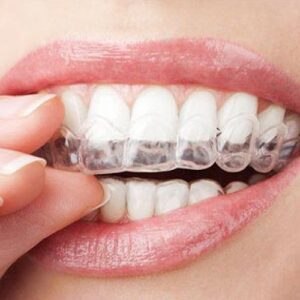 Braces Vs. Invisalign: Choosing The Right Orthodontic Treatment